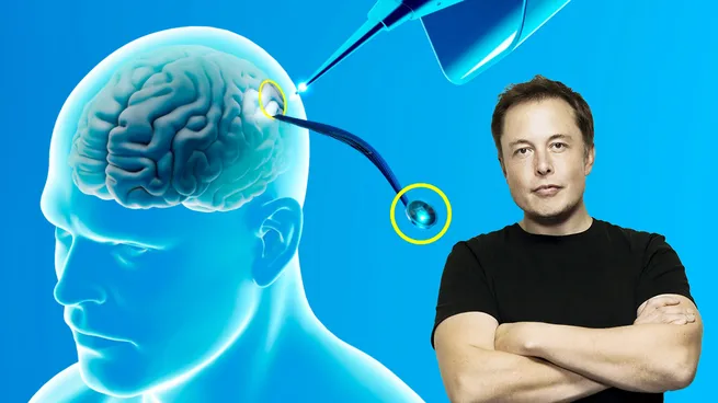 ¿En qué consiste?: Elon Musk anunció que Neuralink implantó por primera vez un chip cerebral en un ser humano