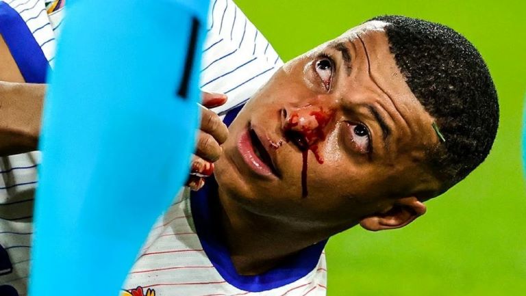 Fútbol: Mbappé no será operado de la fractura en el tabique y jugaría ante Países Bajos por la Eurocopa